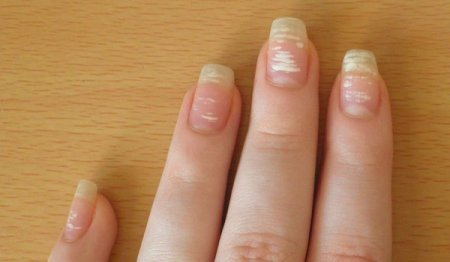 1423579638 bl plyami na ngtyah Білі плями на нігтях: причини і лікування