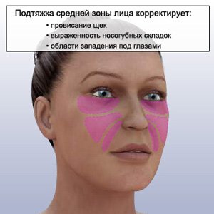  Ендоскопічна підтяжка обличчя (відгуки, фото)