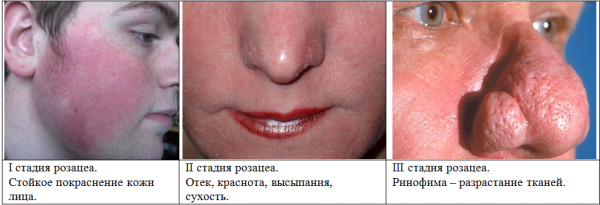 rozacea na oblichch prichini simptomi lkuvannya proflaktika 3 Розацеа на обличчі: причини, симптоми, лікування, профілактика