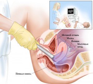  Узд органів малого тазу (матки, придатків) трансвагінально