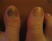  Діагностика захворювань нігтів