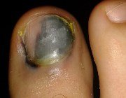  Діагностика захворювань нігтів