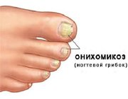  Грибок нігтів на ногах: лікування і профілактика