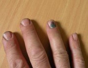  Грибок нігтів рук