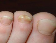  Лікуємо грибок нігтів народними засобами