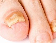  Лікуємо грибок нігтів народними засобами