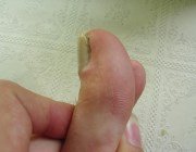  Постановка діагнозу за станом нігтів