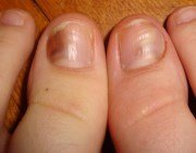  Постановка діагнозу за станом нігтів