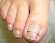  Причини і лікування наривів біля нігтя
