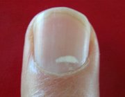  Причини появи білих плям на нігтях