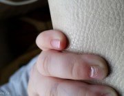 Проблеми на руках дитину: злазять нігті