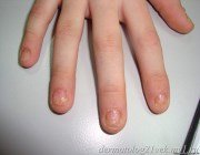  Псоріаз нігтів: діагностування і лікування