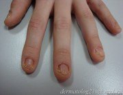  Псоріаз нігтів: діагностування і лікування