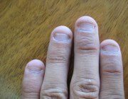  З яких причин шаруються нігті у дитини
