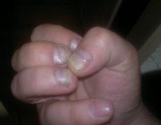  З яких причин шаруються нігті у дитини