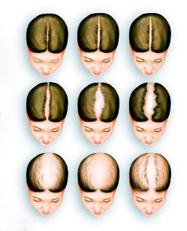  Випадання волосся у жінок: лікування і профілактика