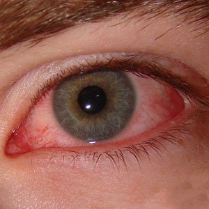  Червоні очі: причини і лікування
