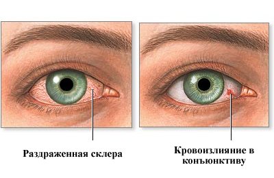  Червоні очі: причини і лікування