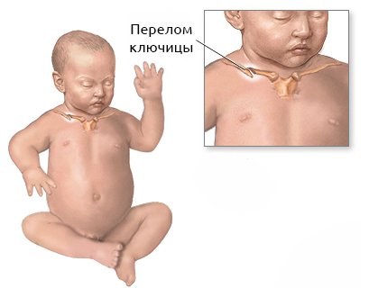 0e48828d729d812a235f84e5b4778470 Перелом ключиці у новонародженого під час пологів: наслідки, лікування
