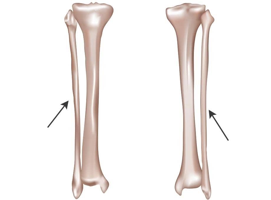 1094134ce12ac3f75989efab2dab6447 Перелом малої гомілкової кістки: лікування та реабілітація, скільки ходити в гіпсі