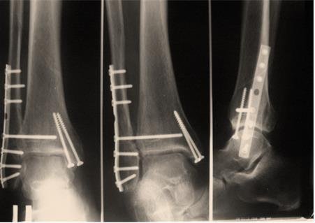 2fa78445f548c86b23afff393b27f408 Перелом ноги (відкритий і закритий): ознаки, скільки ходити в гіпсі