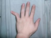 429b3b33caa9c403918f699cf0234816 Перелом мізинця на руці: симптоми, скільки гоїться