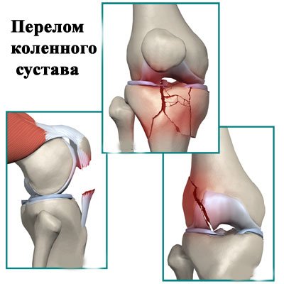 4e3289ea95fe2a50d83e9ae232b88aae Перелом колінного суглоба: лікування, симптоми, реабілітація