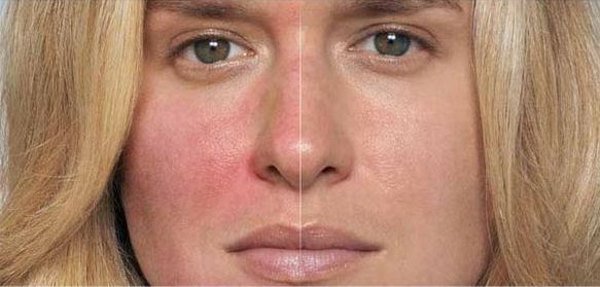 54f31683b64445ab213a5054c886c92c Аскорутин: Інструкція омолодження шкіри обличчя, результати і відгуки