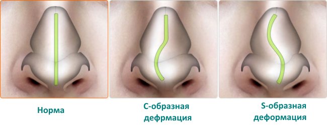 5e12d9b27a30c1853f2e4dc633d76b87 Перелом носа у дитини: симптоми і лікування
