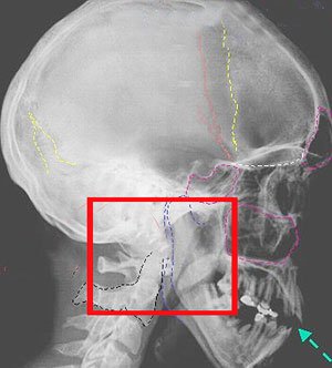 6340a9d66f76121086b9463d21d7adcd Перелом основи черепа: наслідки, виживаність, симптоми