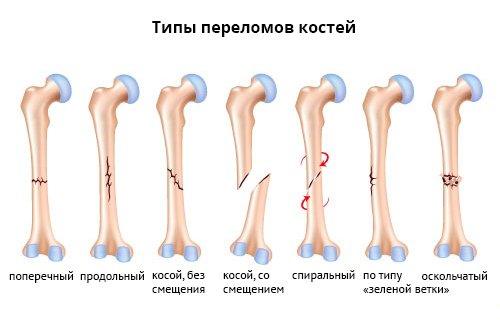 8dd162c280fd595cb95fd27c82d0f67c Перелом ноги (відкритий і закритий): ознаки, скільки ходити в гіпсі