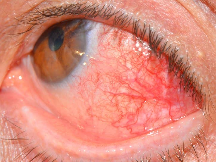 dd42dbfd8e3d245a5b227cf840621d3b Пошкодження рогівки ока: лікування і наслідки травми