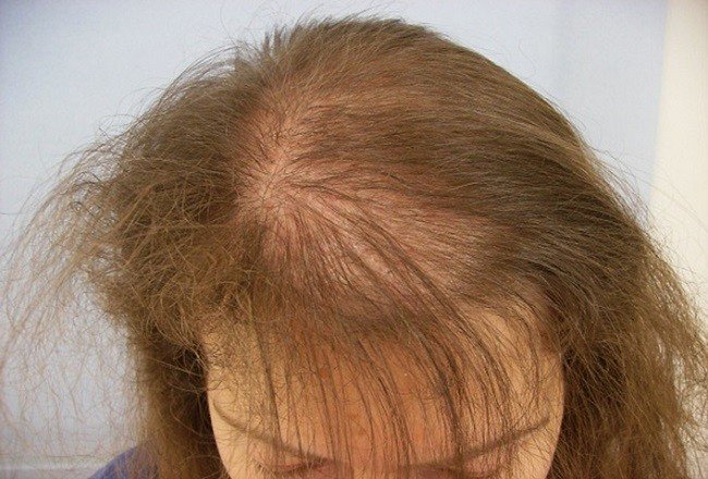 e688cc11cd46618f8b4b096ae0d9eee3 Народні засоби від випадіння волосся у жінок в домашніх умовах