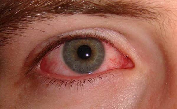 ecf1ed9a70a0660ac7ce3cdec196fa66 Конюнктивіт очей — симптоми, ознаки і прояви у дорослих