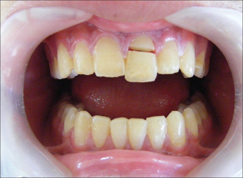 efc3cf9c53540ee5f5ed29a06a2d4781 Перелом зуба (кореня): ознаки, відновлення