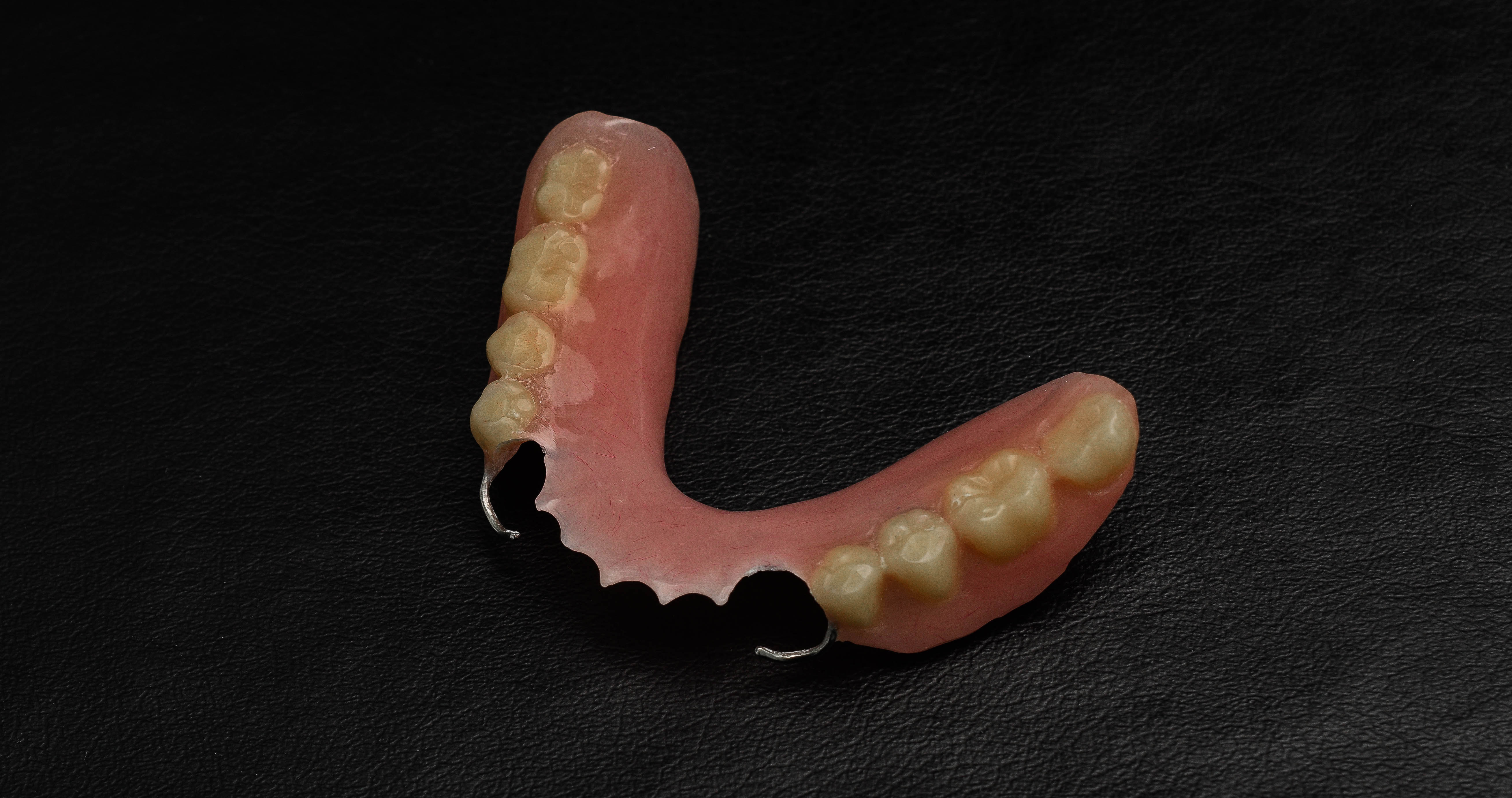 81470c11f4008f8d08a482ec92ee1fce Які зуби краще вставляти пластмасові або керамічні: відмінність, ціна, характеристики