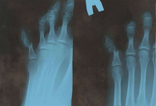 02e84bed634fe79724bfcceb5d9621b7 Перелом мізинця на нозі: симптоми, що робити, як швидко вилікувати