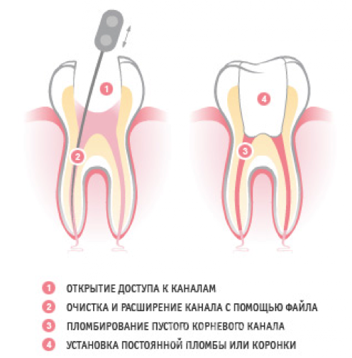 Сколько ходят с лекарством в зубе. Этапы пломбирования корневых каналов при пульпите. После постановки пломбы болит зуб.