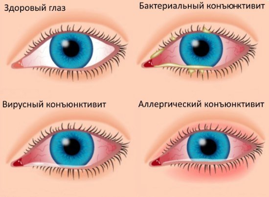 0d6450e7260c6787cb4e35fdaac23649 Конюнктивіт очей. Причини, лікування у дорослих. Як передається конюнктивіт