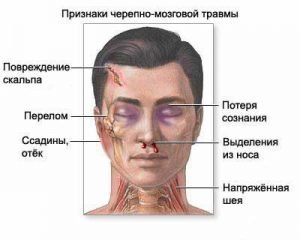 14d00c9c2492a6345edea4a2b895286f Перелом склепіння черепа: причини, симптоми і лікування