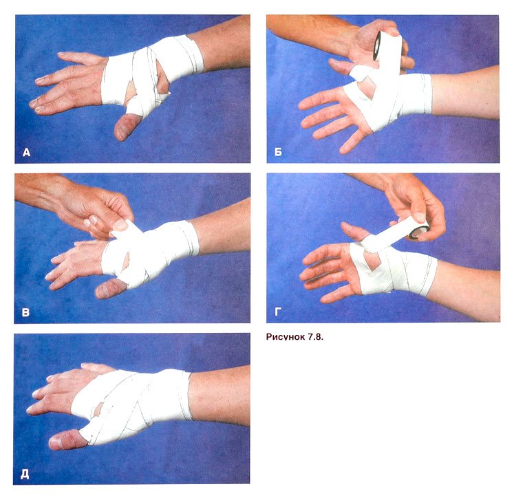 1b7a6f1712f554d25b6fd62369a391a7 Розтягнення звязок кисті руки: лікування в домашніх умовах