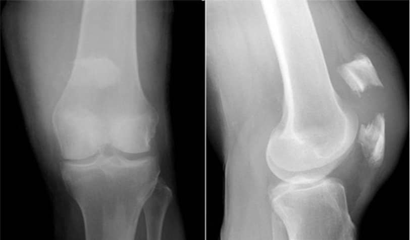 26078b2c90321c32e5d7caac17cfda67 Перелом надколінка (колінної чашечки): наслідки, реабілітація