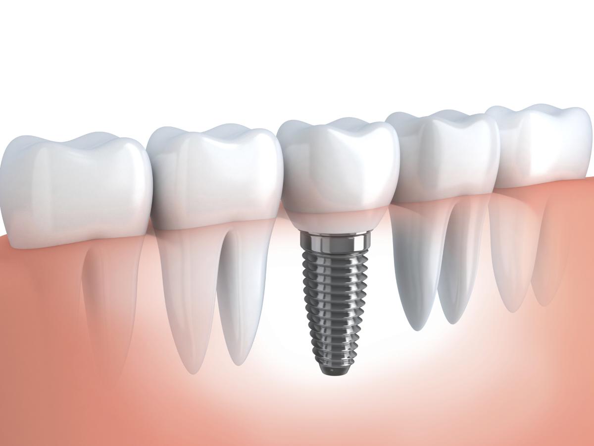2cc5d98a967d7173a9882dd361860979 Перелом зуба (кореня): ознаки, відновлення