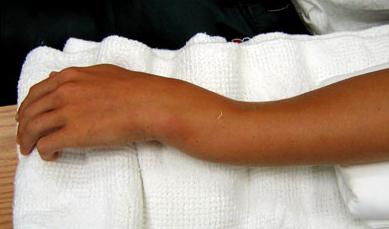 398c9583d95cec93af6e466743b58fe7 Перелом руки зі зміщенням: скільки носити гіпс, лікування