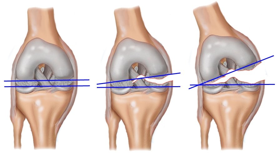 3e7af44ae35e37519dea0e0d05f7cc11 Розрив звязувань колінного суглоба: скільки гоїться, симптоми, лікування