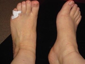 42a87f9e3ae0db9411df72b4c78bb64a Перелом мізинця на нозі: симптоми, що робити, як швидко вилікувати