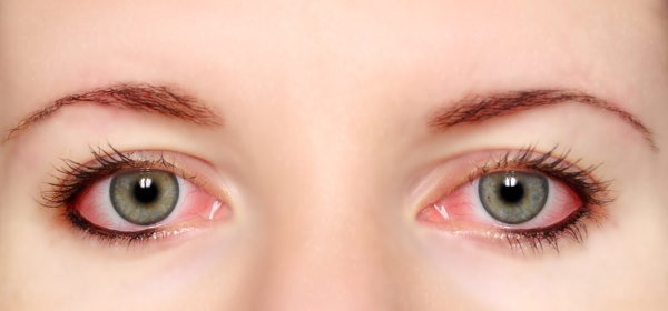 431fac3a7432811d10db00952bc53bb6 Конюнктивіт очей. Причини, лікування у дорослих. Як передається конюнктивіт