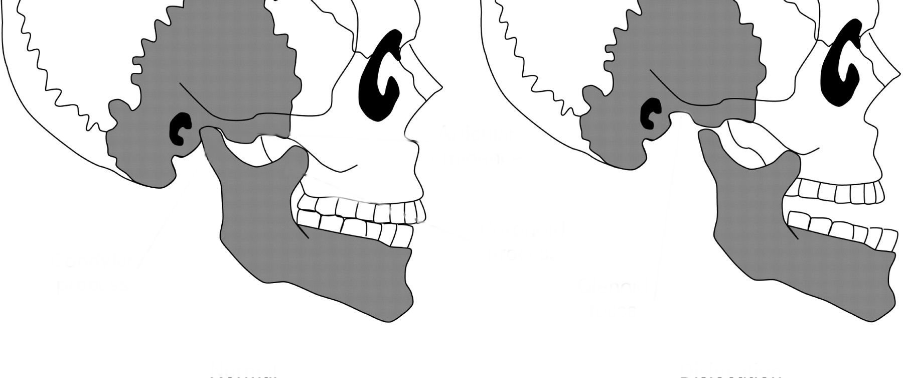 Подвижное соединение челюстей. Вывих височно-нижнечелюстного сочленения (вывих нижней челюсти). Подвывих височно-нижнечелюстного сустава. Передний двусторонний вывих нижней челюсти.