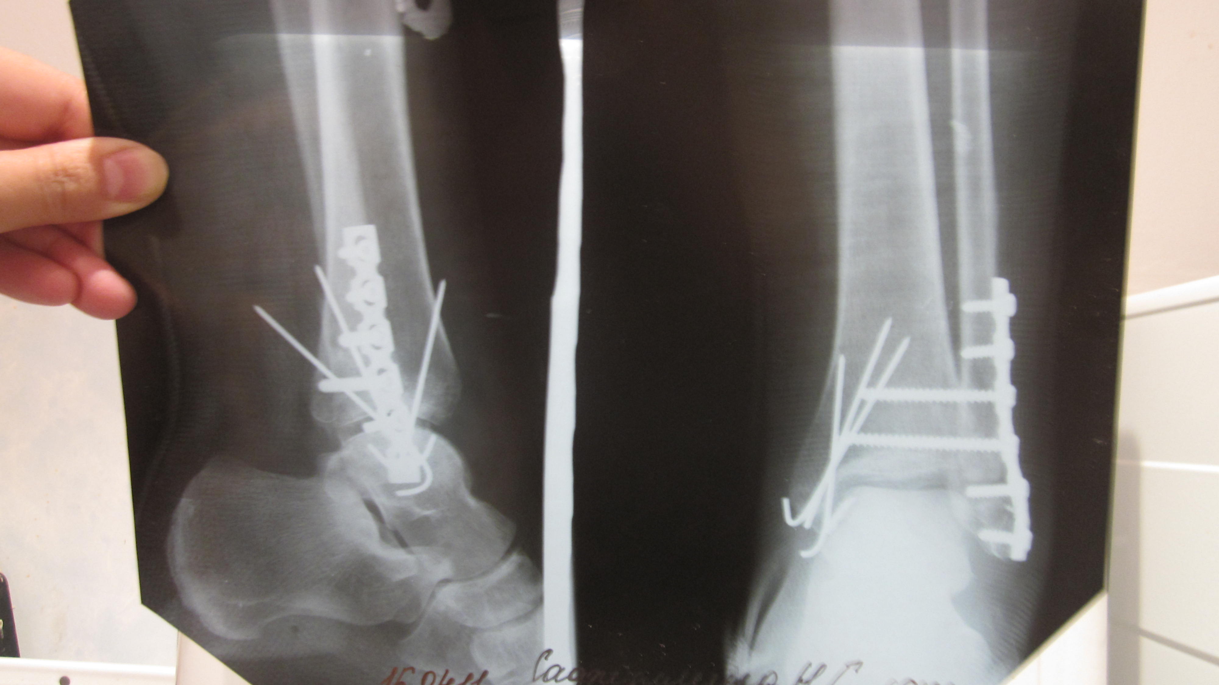 6 недель перелом. Остеосинтез трехлодыжечный перелом. Трехлодыжечный перелом лодыжки. Перелом лодыжки трехлодыжечный перелом. Трехлодыжечный перелом рентген.