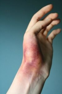 4c37ecda7543ad27fdcafbea8b3db18f Перелом руки зі зміщенням: скільки носити гіпс, лікування